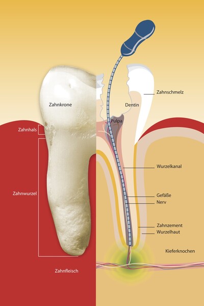 Wurzelkanalbehandlung